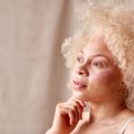 Albinism Awareness Month puts overlooked skin cancer risks in focus