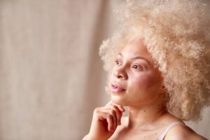 Albinism Awareness Month puts overlooked skin cancer risks in focus