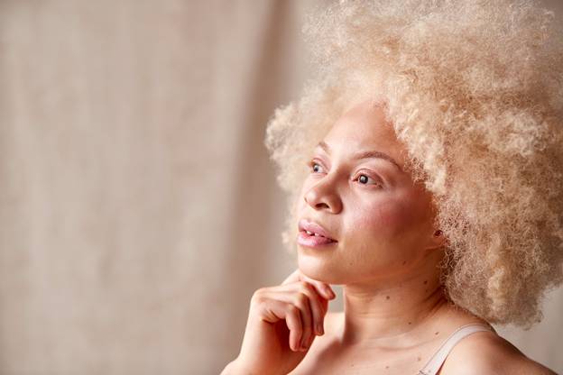 Albinism Awareness Month puts overlooked skin cancer risks in focus